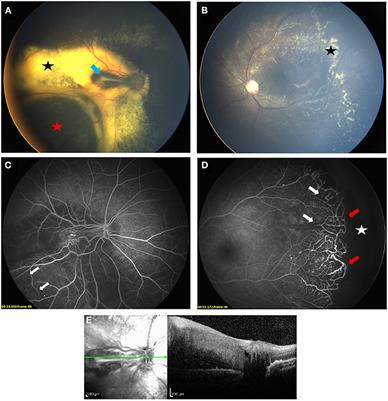 Coats disease in female population: A comparison of clinical presentation and outcomes